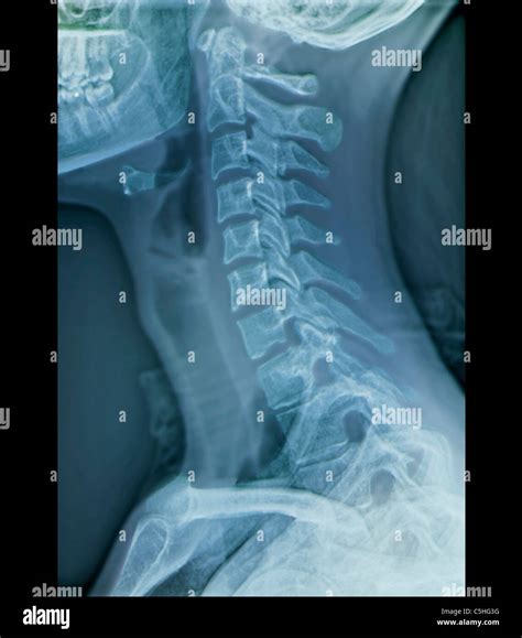 Image result for Neck X-Ray