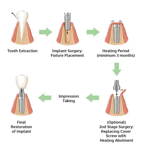 Tooth Implants Procedure 的图像结果