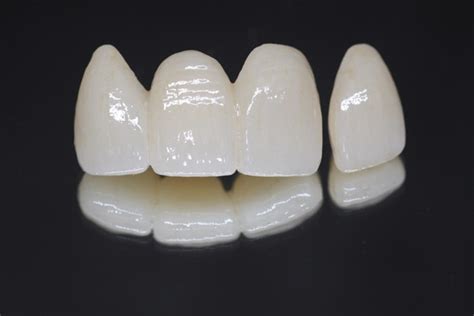 Homemade Dental Bridge 的图像结果