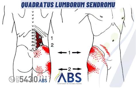 Quadratus Lumborum Sendromu - Uz. Fzt. Ahmet Burak Sezgin