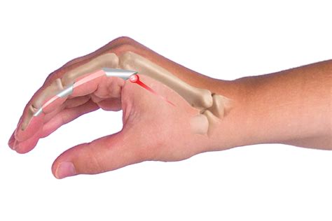 Trigger Finger Splints, Braces & Immobilizer Casts for Fractures