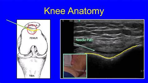 Injection Therapy 的图像结果