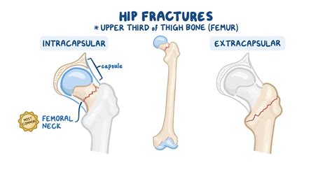 Hip Fracture Types