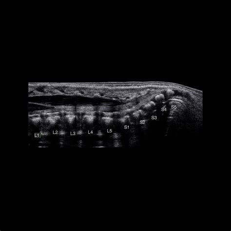 Newborn with a sacral dimple | Pediatric Radiology Case | Pediatric Imaging | @pedsimaging ...