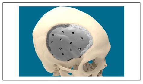 Ceramic 3D-Printed Titanium Cranioplasty