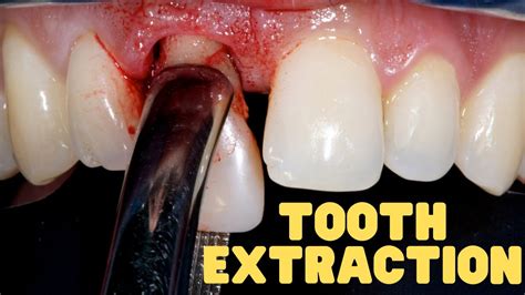 Image result for New Technology Tooth Extraction
