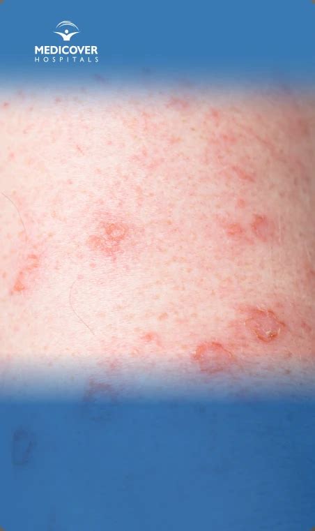 Skin Redness and Blisters Causes and Care