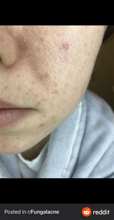 Gram Negative Folliculitis? – Acne – Acne.org Forum