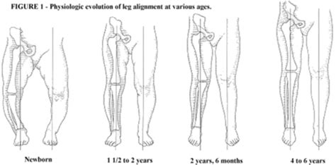 Image result for Normal Leg Alignment