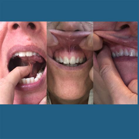 Is Sleep Apnea Hereditary? How Tongue, Lip, and Cheek Ties Shape Your ...