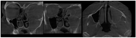 A Retrospective Study on Silent Sinus Syndrome in Cone Beam-Computed Tomography Images—Author ...
