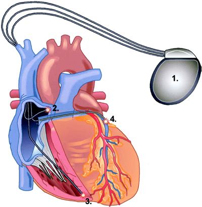 Pacemaker Procedure 的图像结果