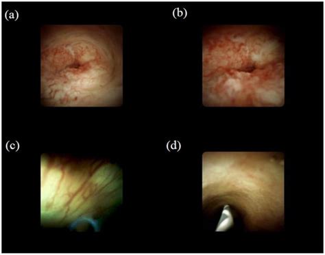 Diagnostic Process Using Endoscopy for Biliary Strictures: A Narrative ...