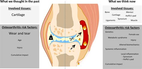 Inflammation in osteoarthritis: Our view on its presence and involvement in disease development ...
