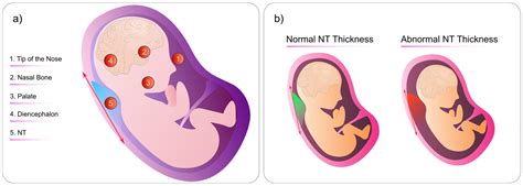 Enhancing Fetal Anomaly Detection in Ultrasonography Images: A Review ...