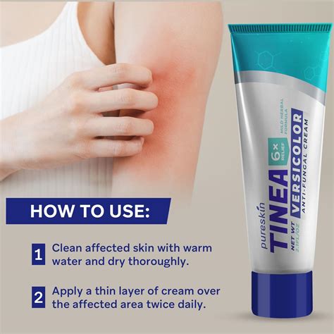 Tinea Versicolor Crema de tratamiento de hongos antifúngico para tiña versicolor tiña – Extra ...