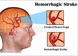 Image result for Hemorrhagic