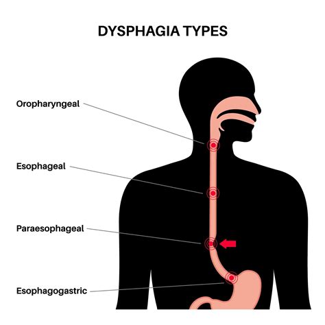 Odynophagia Vs Dysphagia