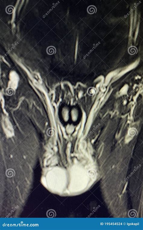 Pelvic Mri Diagnostic Varicocele Pathology Man Stock Photo - Image of ...