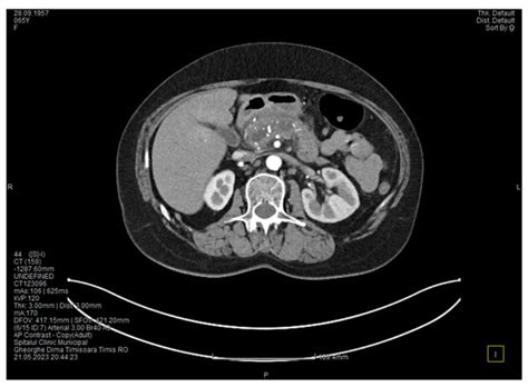 Pancreaticoduodenectomy with Anatomical Vascular Variant in Groove ...