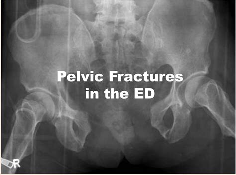 Stress Fracture Pelvis Symptoms at Elma Thomas blog