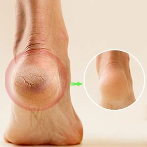 DALUCI Silicone Gel Heel Pad Socks for Heel Swelling Pain Relief Ankle ...