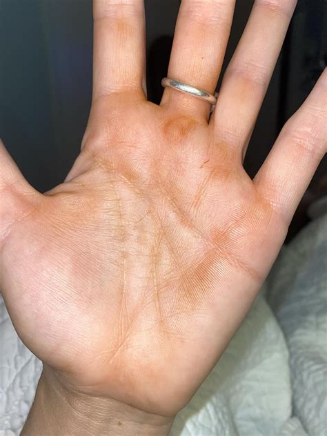 Image result for Exploding Orange Hand Injury