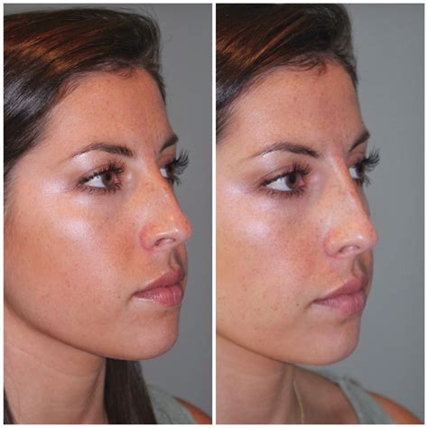 🥇 Atlanta Botox, Juvederm, Laser Treatment Before and After Photos