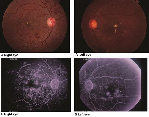 Case Report Diabetic Retinopathy at Garry Richmond blog