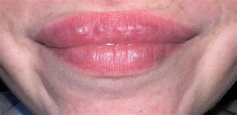 Lumps in lip 5 months post filler normal? : r/PlasticSurgery