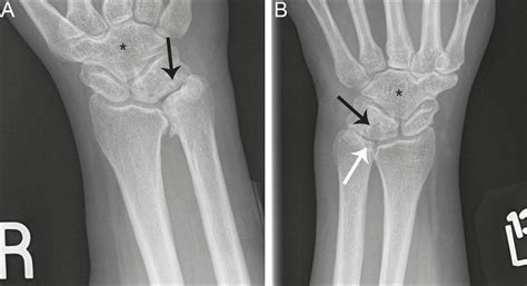SciELO Brasil - Lunotriquetral coalition and ulnar impaction syndrome: a pictorial essay ...