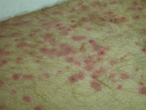 Shingles (Herpes Zoster) as related to Infections - Pictures