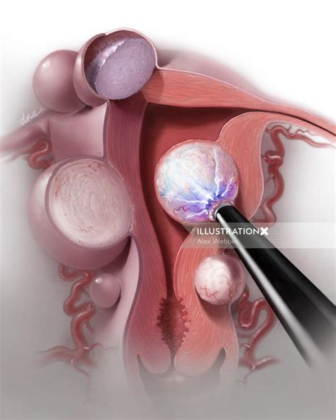 Radiofrequency Ablation of Uterine Fibroids | Illustration by Alex Webber