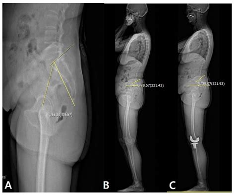 Spinal Flexibility Is an Important Factor for Improvement in Spinal and ...