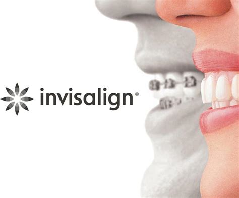 Invisalign Open day event | Dental Arch Clinic