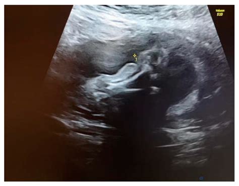 Amniotic Band Syndrome—Prenatal Diagnosis