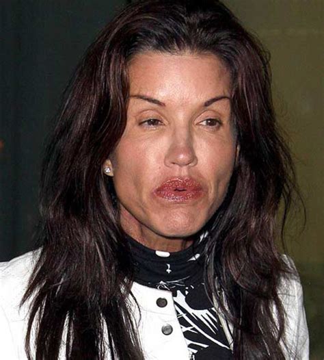 Face Lifts Gone Wrong