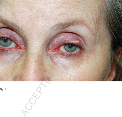 Psoriasis Eyelid
