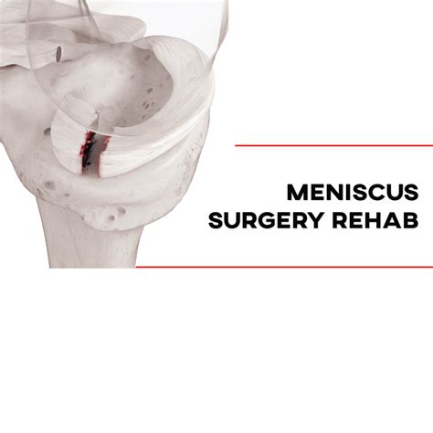 Meniscus Surgery Rehab [P]rehab