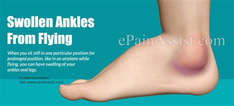 Swollen Ankles From Flying: Causes, Treatment, Prevention