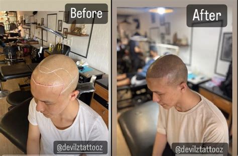 Scalp Micropigmentation Images Before and After Results & Reviews