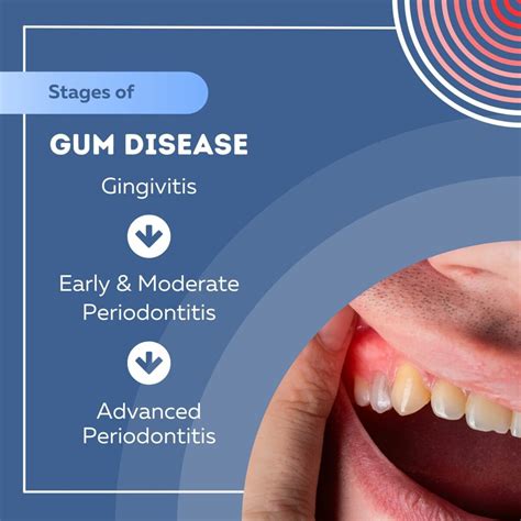 Understanding the Stages of Gum Disease - Dr. Salim Kapadia Dental Centre
