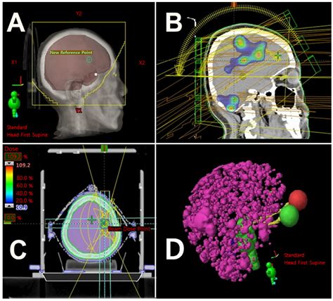 Selecting the Appropriate Radiation Therapy Technique for Extensive ...