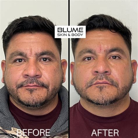 Dermal Fillers Forehead 的图像结果