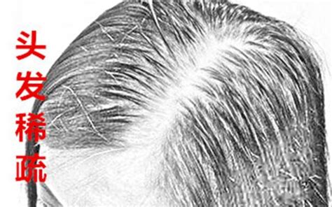 大麦微针植发4000单位，感受头发从稀疏到茂密-发友网