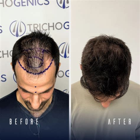 Are Hair Transplants Permanent? All you need to know