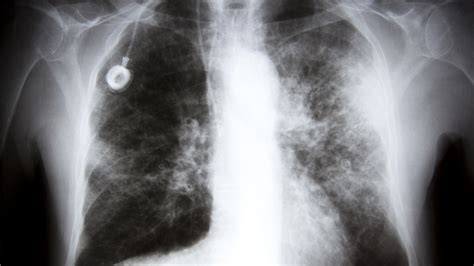Daily Dose - Treating Stage IV Lung Cancer With a Pill