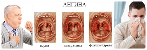 Ангина: симптомы, причины, лечение у детей и взрослых, фото ангины