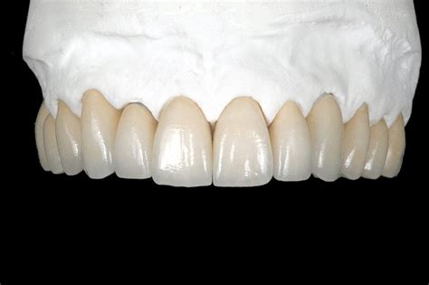 Zirconia || Smile Stones Dental Pvt Ltd