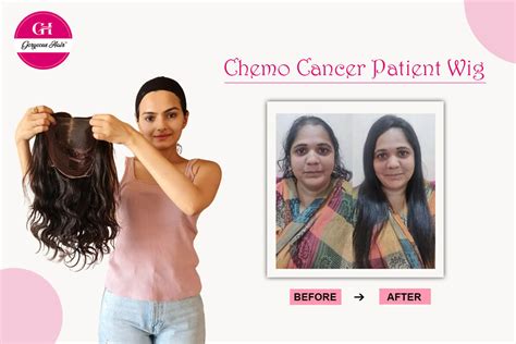 Can Cancer Wigs Help Patients Regain Their Lost Sense Of Self-worth ...